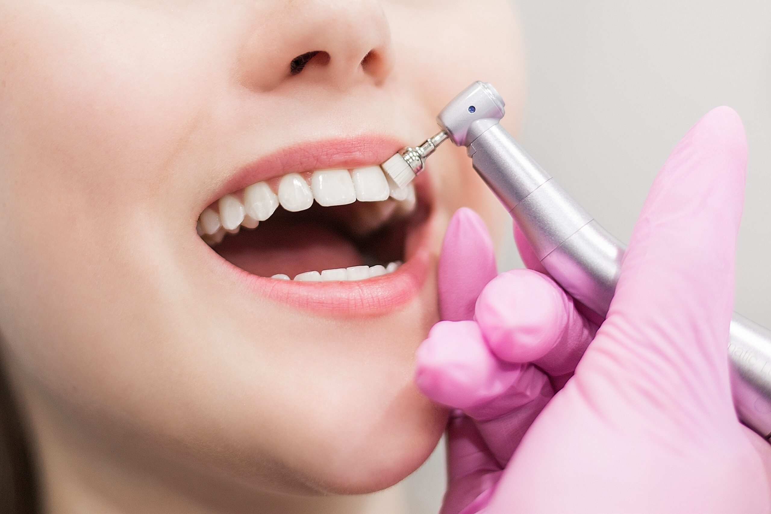 Scaling & Polishing at Keluarga Dental Smile, Sentul Kuala Lumpur